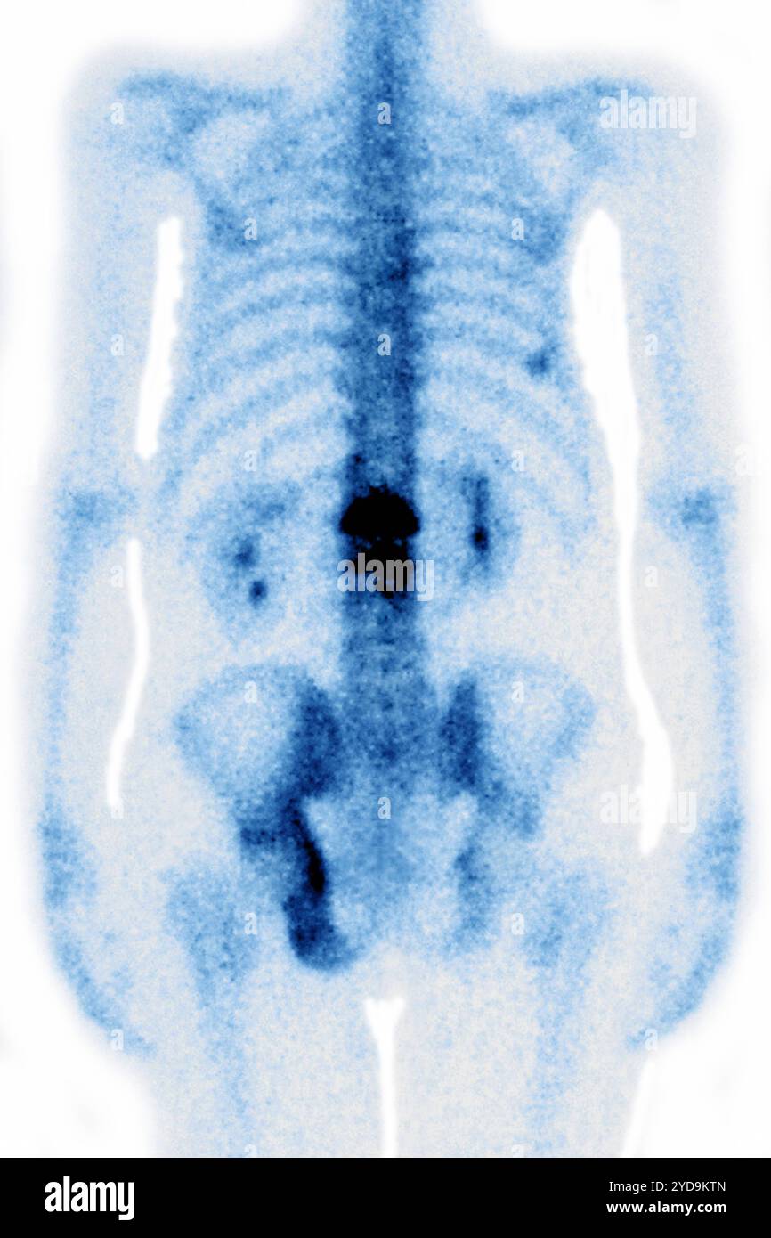 Ostéoporose lombaire provoquant compression et fractures des vertèbres lombaires. Radiographie des vertèbres lombaires vue de face. Ostéoporose lombaire. 016836_037 Banque D'Images