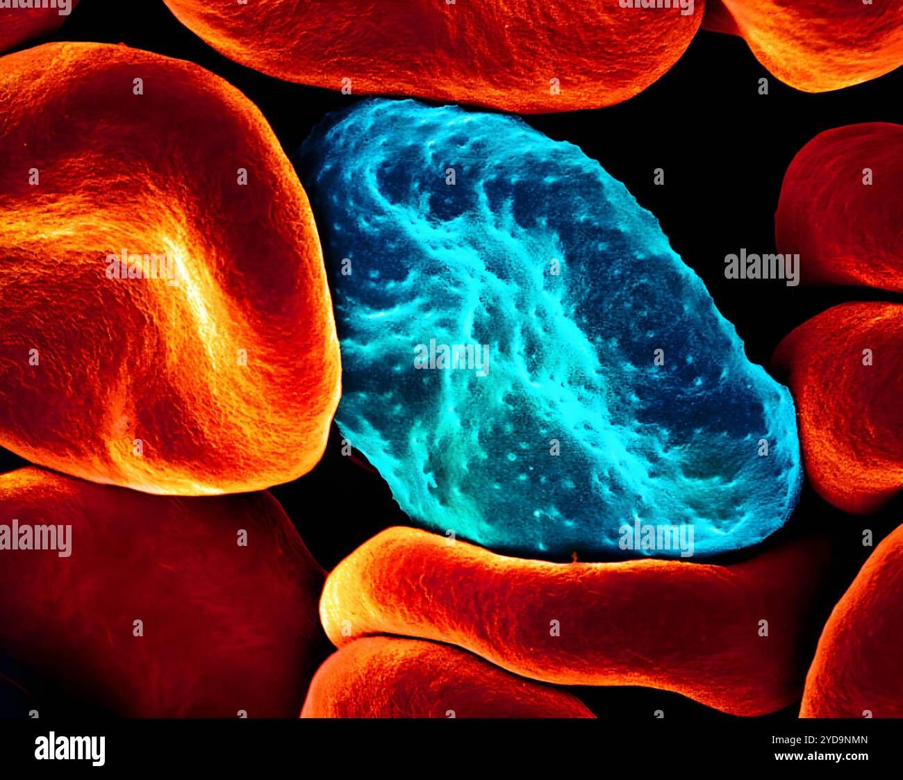 Micrographie électronique à balayage colorisé d'un globule rouge infecté par des parasites du paludisme bleu/sarcelle. Les petites bosses sur la cellule infectée montrent comment le parasite remodèle sa cellule hôte en formant des protubérances appelées boutons à la surface, ce qui lui permet d’éviter la destruction et de provoquer une inflammation. Les cellules non infectées orange/rouge/jaune ont des surfaces plus lisses. Globules rouges infectés par des parasites du paludisme 016867 015 Banque D'Images