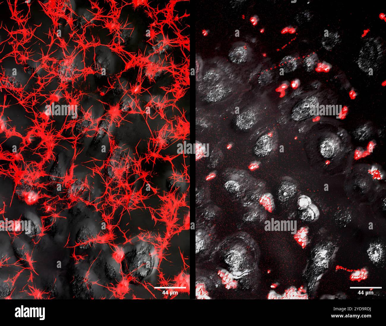 Images côte à côte montrant des dépôts de fibrine en forme de chaîne rouge associés à des cellules épithéliales pulmonaires humaines infectées par SARS-CoV-2 gauche et aux mêmes cellules non infectées en présence de fibrinogène rouge/fluorescent droit. Fibrose pulmonaire induite par COVID 016867_159 Banque D'Images