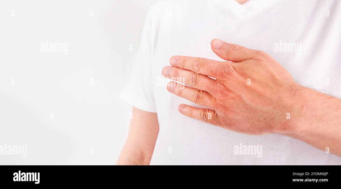 Homme gratte ou montre les mains avec la peau sèche et fissurée sur fond blanc. Problème avec beaucoup de gens - eczéma sur la main, allergies ou peau sèche. Voiture de santé Banque D'Images Homme gratte ou montre les mains avec la peau sèche et fissurée sur fond blanc. Problème avec beaucoup de gens - eczéma sur la main, allergies ou peau sèche. Voiture de santé Banque D'Images