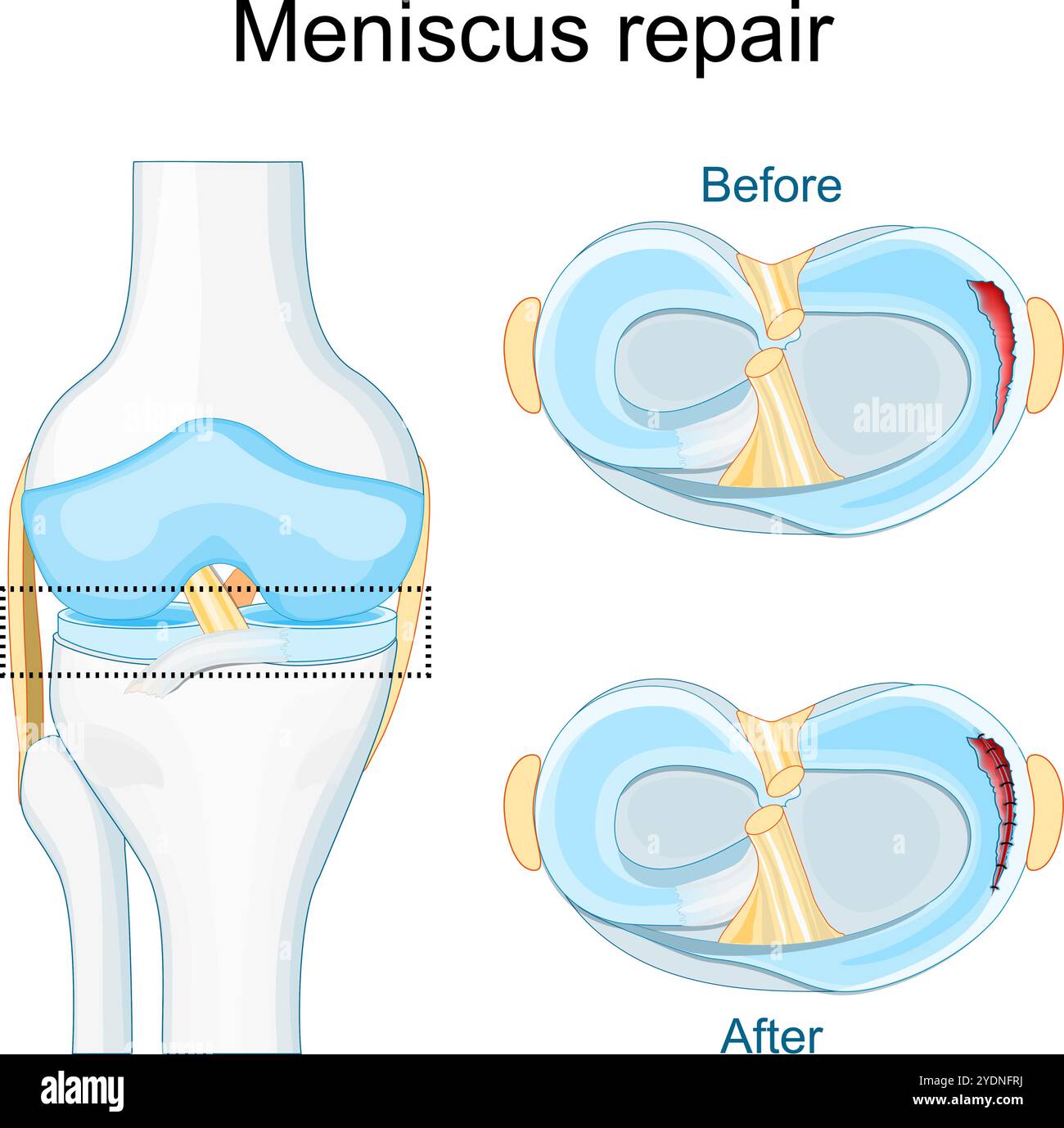 Traumatisme ménisque. Gros plan de l'articulation du genou. Déchirure méniscale avant et après chirurgie. Réparation de sutures. Cicatrisation méniscale. Vue de dessus d'un genou humain. Pos. Vectorielle Illustration de Vecteur