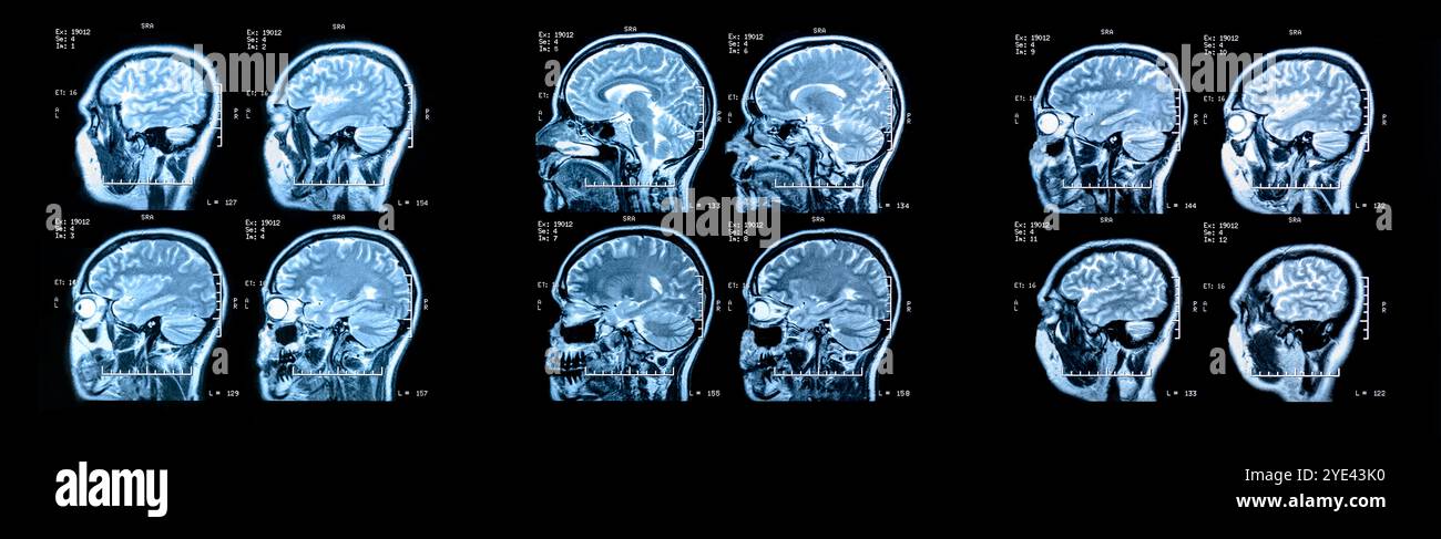 IRM image d'un cerveau humain montrant toute la sclérose en plaques principale Banque D'Images