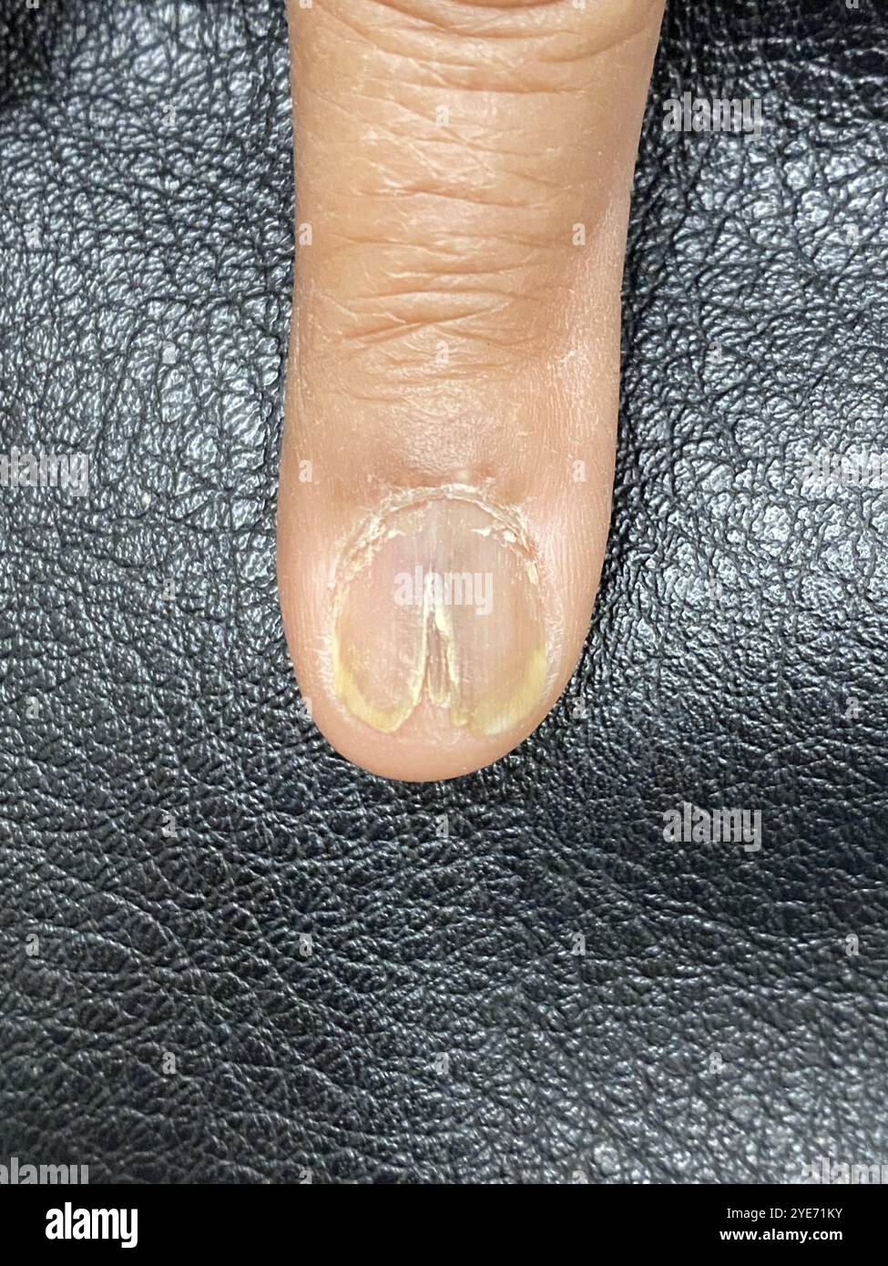 Fendu dans l'ongle d'un patient qui a résulté après qu'une biopsie au poinçon a été prise de la région. Banque D'Images