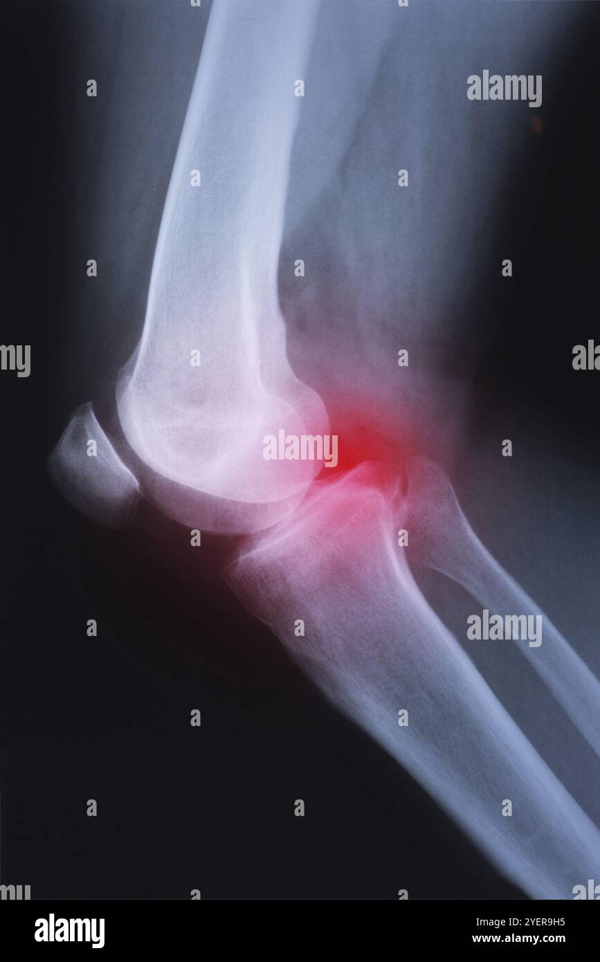 Radiographie médicale de l'articulation du genou avec arthrite (goutte, polyarthrite rhumatoïde, arthrite septique, arthrose du genou) Banque D'Images