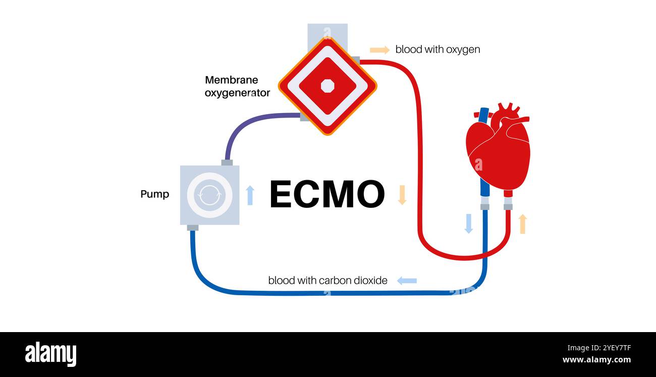 Illustration conceptuelle de l'oxygénation extracorporelle membranaire. Ce système circulatoire mécanique artificiel peut aider une personne dont les poumons et le cœur ne fonctionnent pas correctement. Banque D'Images
