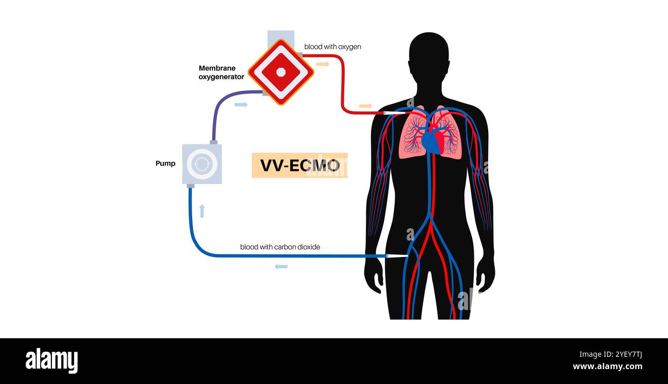Illustration conceptuelle de l'oxygénation extracorporelle membranaire. Ce système circulatoire mécanique artificiel peut aider une personne dont les poumons et le cœur ne fonctionnent pas correctement. L'ECMO veino-veineuse (VV) est utilisée pour le soutien pulmonaire uniquement. Banque D'Images