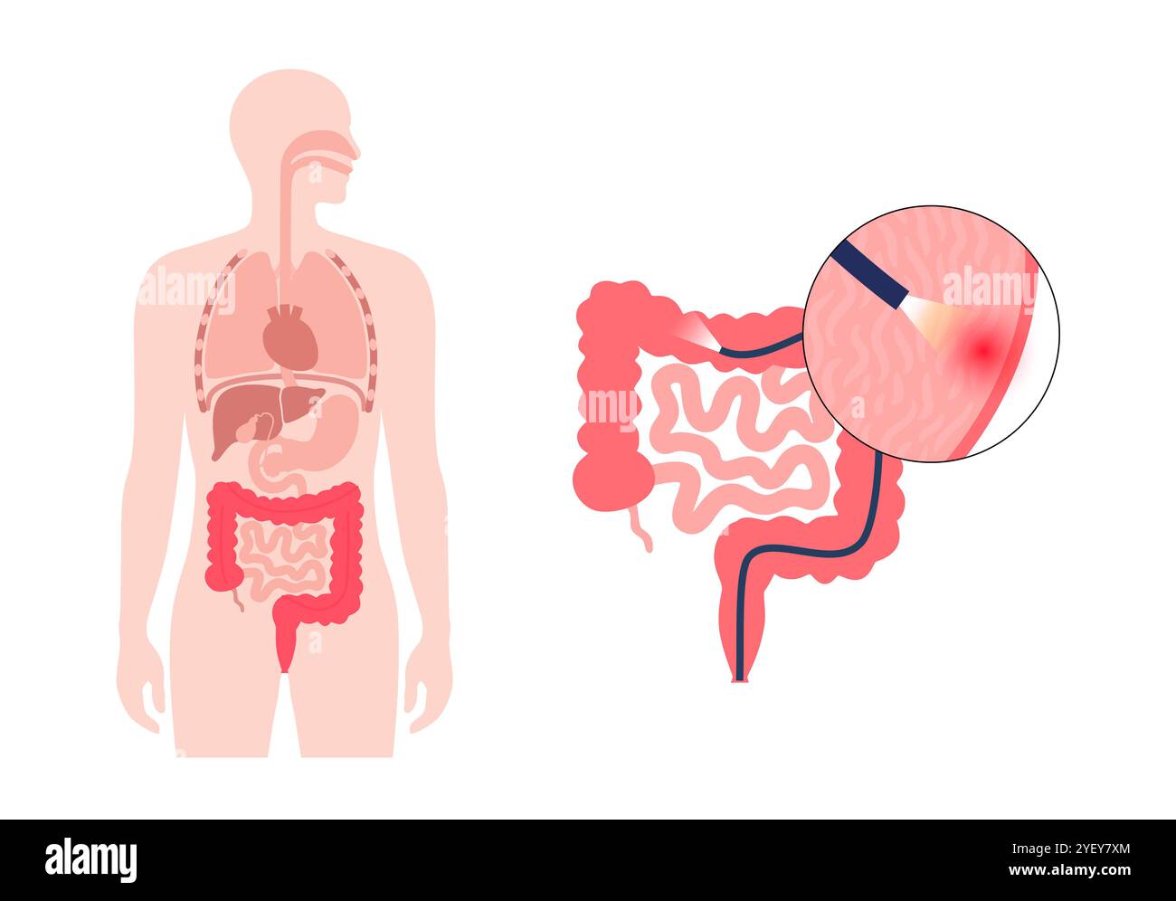 Illustration conceptuelle d'un procédé de coloscopie. Il s'agit d'un examen de l'intérieur de votre gros intestin, qui comprend le côlon, le rectum et l'anus. Il peut être utilisé pour explorer les causes possibles des douleurs abdominales, des saignements rectaux, des diarrhées chroniques et d'autres problèmes gastro-intestinaux. Il est également utilisé pour rechercher des signes possibles de cancer colorectal ou de polypes. Banque D'Images