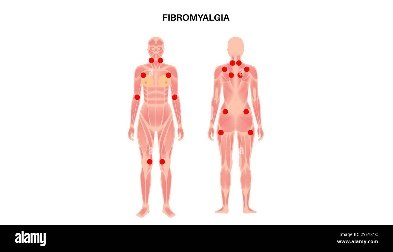 Illustration conceptuelle de la fibromyalgie. La fibromyalgie est une affection chronique qui cause de la douleur et de la sensibilité dans tout le corps, ainsi que de la fatigue et des troubles du sommeil. La cause exacte est inconnue, mais elle est souvent déclenchée par le stress physique ou psychologique. Banque D'Images