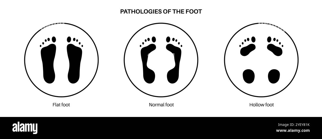 Illustration conceptuelle des pathologies du pied, y compris les pieds plats, normaux et creux. Un pied plat n'a pas de voûte plantaire ou une voûte plantaire très basse alors qu'un pied creux est caractérisé par une voûte excessive. Banque D'Images