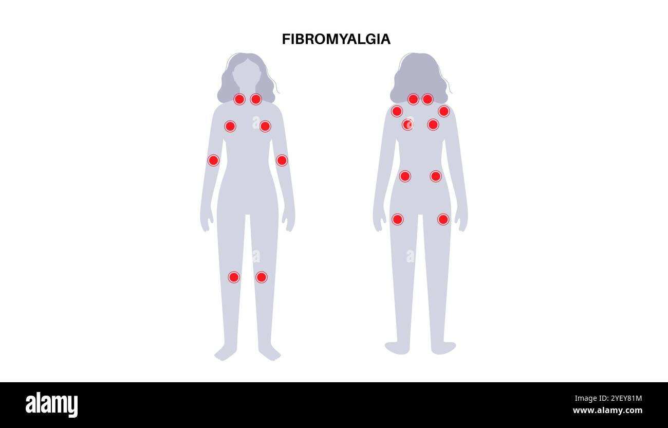 Illustration conceptuelle de la fibromyalgie. La fibromyalgie est une affection chronique qui cause de la douleur et de la sensibilité dans tout le corps, ainsi que de la fatigue et des troubles du sommeil. La cause exacte est inconnue, mais elle est souvent déclenchée par le stress physique ou psychologique. Banque D'Images