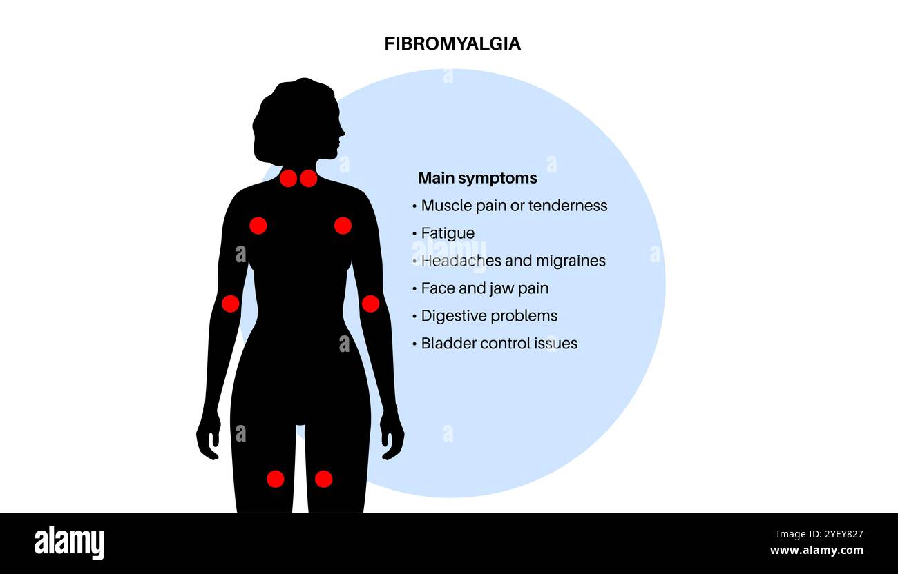 Illustration conceptuelle de la fibromyalgie. La fibromyalgie est une affection chronique qui cause de la douleur et de la sensibilité dans tout le corps, ainsi que de la fatigue et des troubles du sommeil. La cause exacte est inconnue, mais elle est souvent déclenchée par le stress physique ou psychologique. Banque D'Images