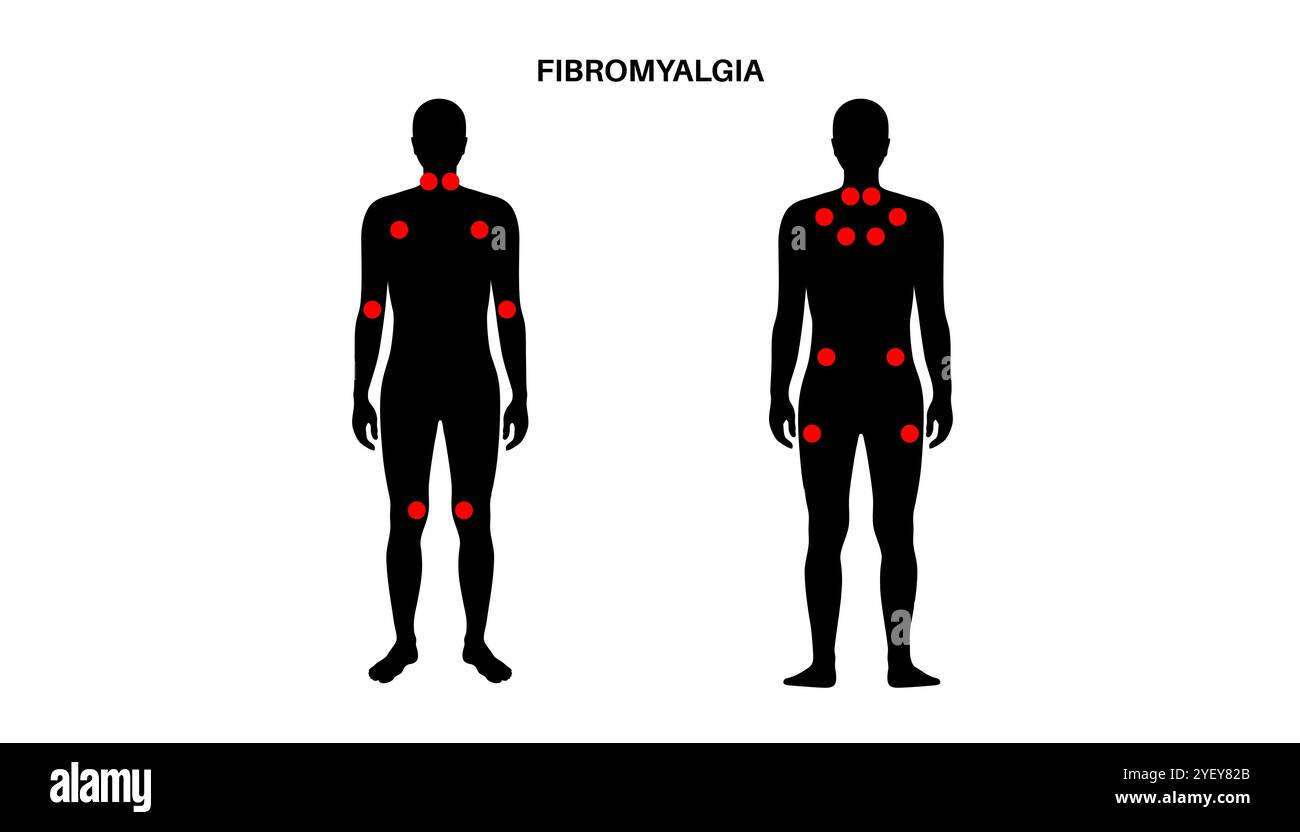 Illustration conceptuelle de la fibromyalgie. La fibromyalgie est une affection chronique qui cause de la douleur et de la sensibilité dans tout le corps, ainsi que de la fatigue et des troubles du sommeil. La cause exacte est inconnue, mais elle est souvent déclenchée par le stress physique ou psychologique. Banque D'Images