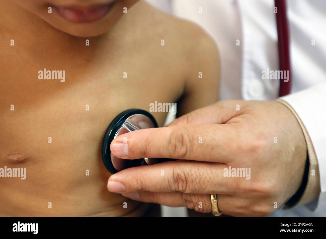 L'hôpital Calmette. L'enfant atteint de cardiopathie congénitale. L’ONG française chaine de l’espoir assure un traitement gratuit. Phnom Penh. Cambodge. Hôpital Calmette 016757 173 Banque D'Images