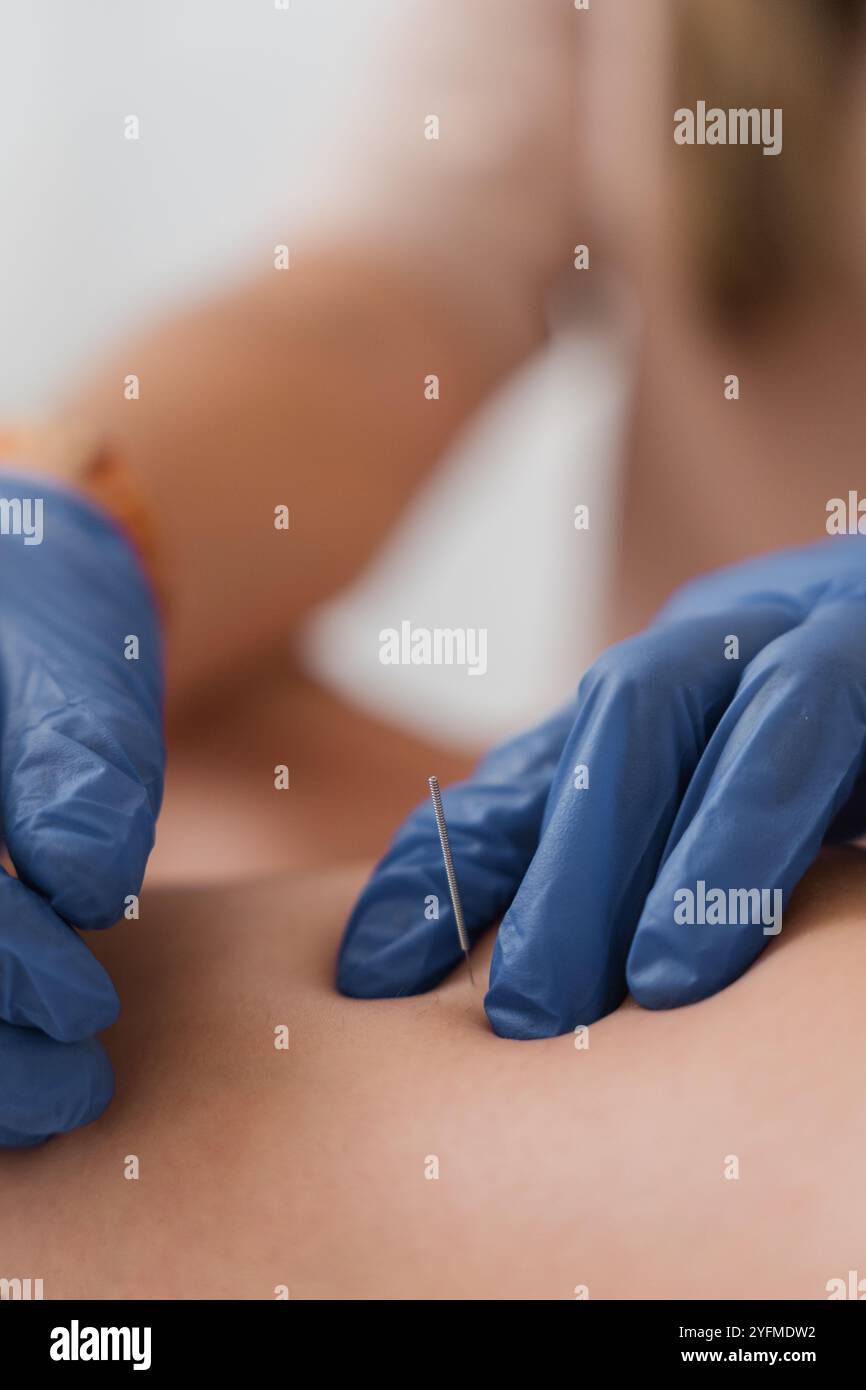 Physiothérapeute appliquant une aiguilletage sec sur le dos du patient Banque D'Images