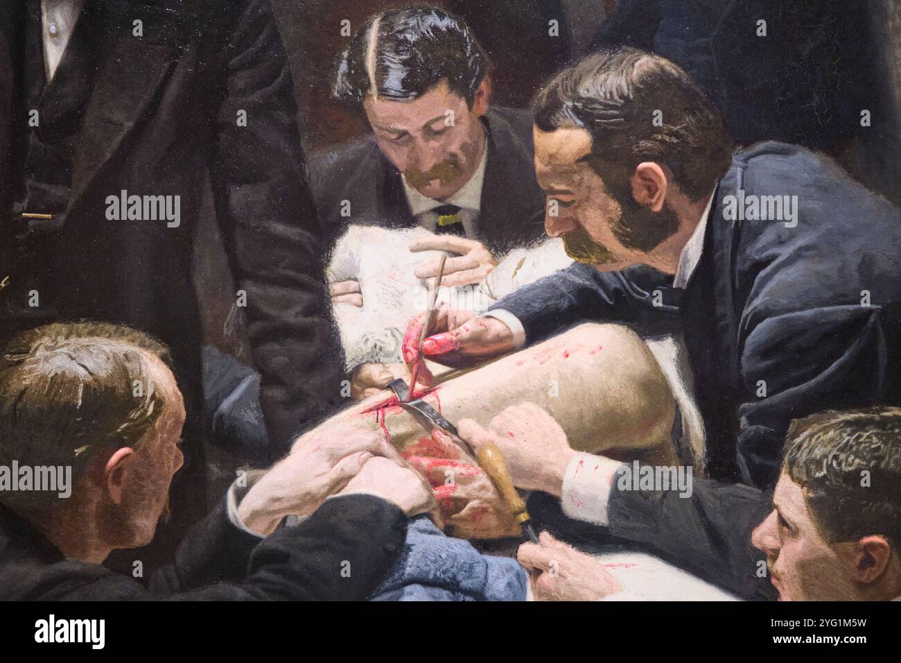 Le Thomas Eakins médical, peinture chirurgicale, la clinique Gross, détaillant une opération sanglante de la cuisse. Au Philadelphia Museum of Art en Pennsylvanie. Banque D'Images