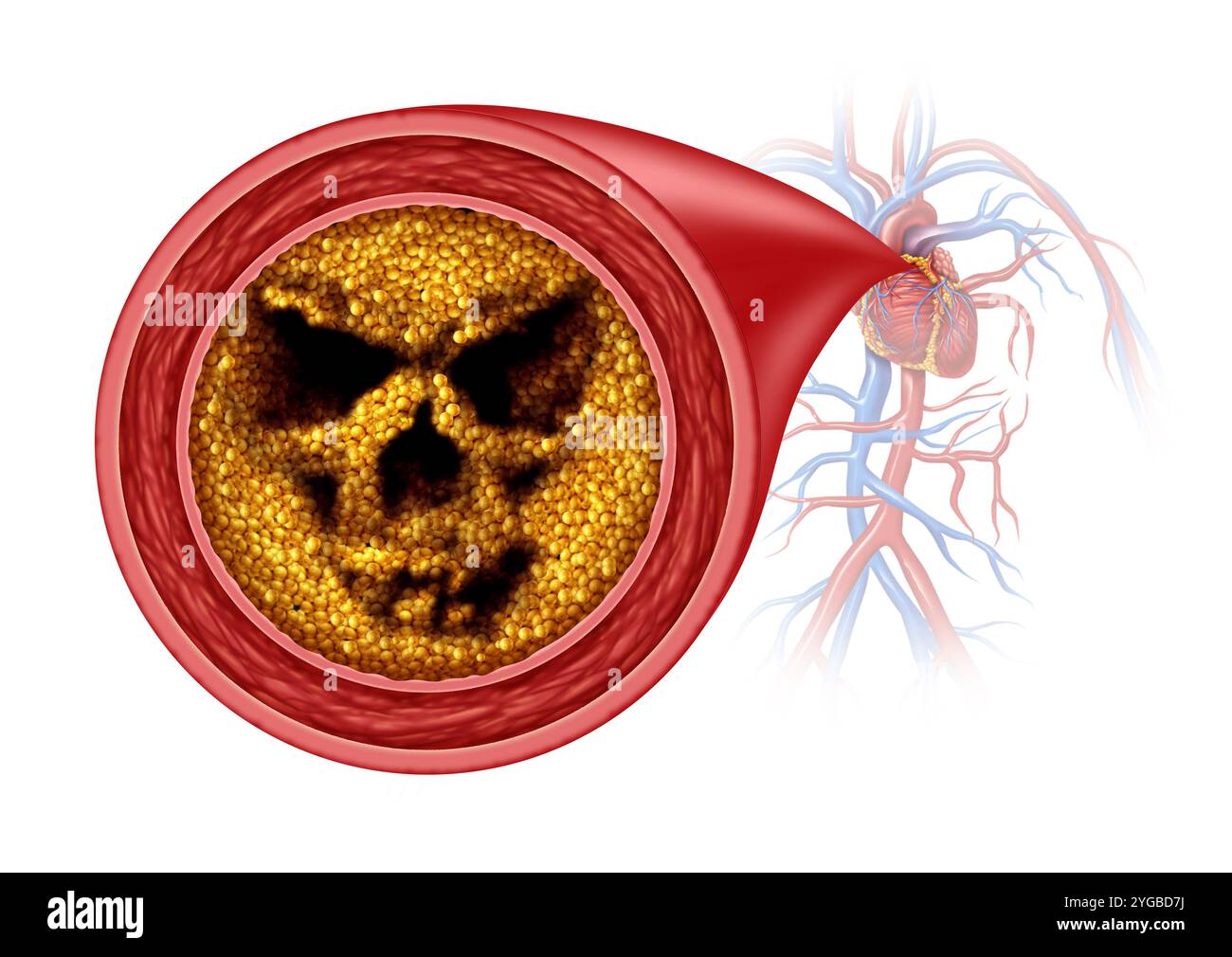 Artère obstruée danger et athérosclérose condition médicale comme artères humaines bloquées et flux sanguin restreint comme un vaisseau sanguin avec mortel Banque D'Images
