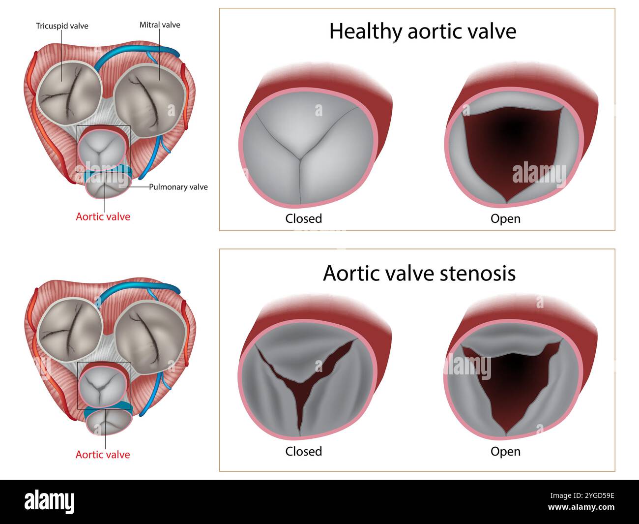 Rétrécissement valvulaire aortique et valve aortique saine. Cardiopathie valvulaire. Illustration de Vecteur