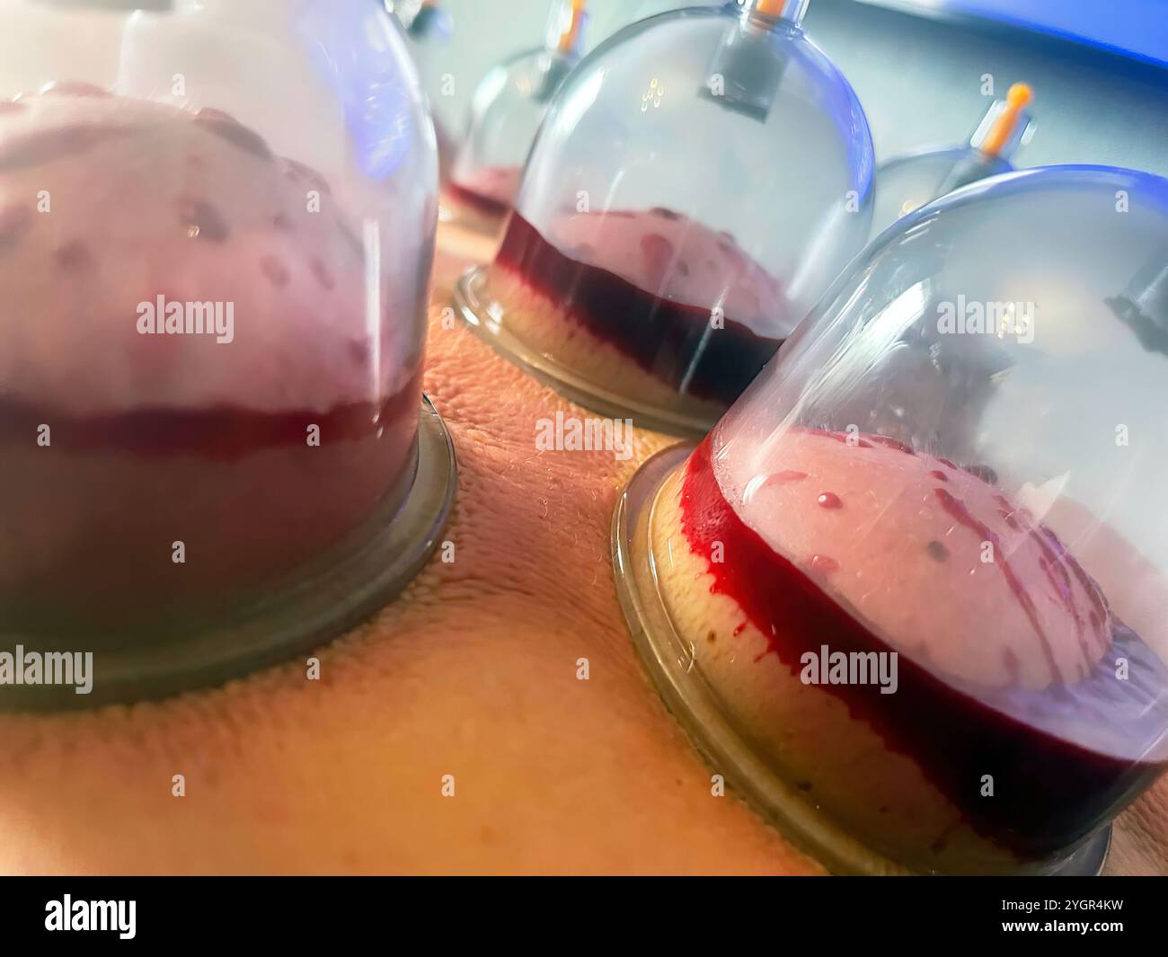 Le pouvoir curatif de Hijama : avantages de Cupping pour les saignées. Affûtage sélectif Banque D'Images