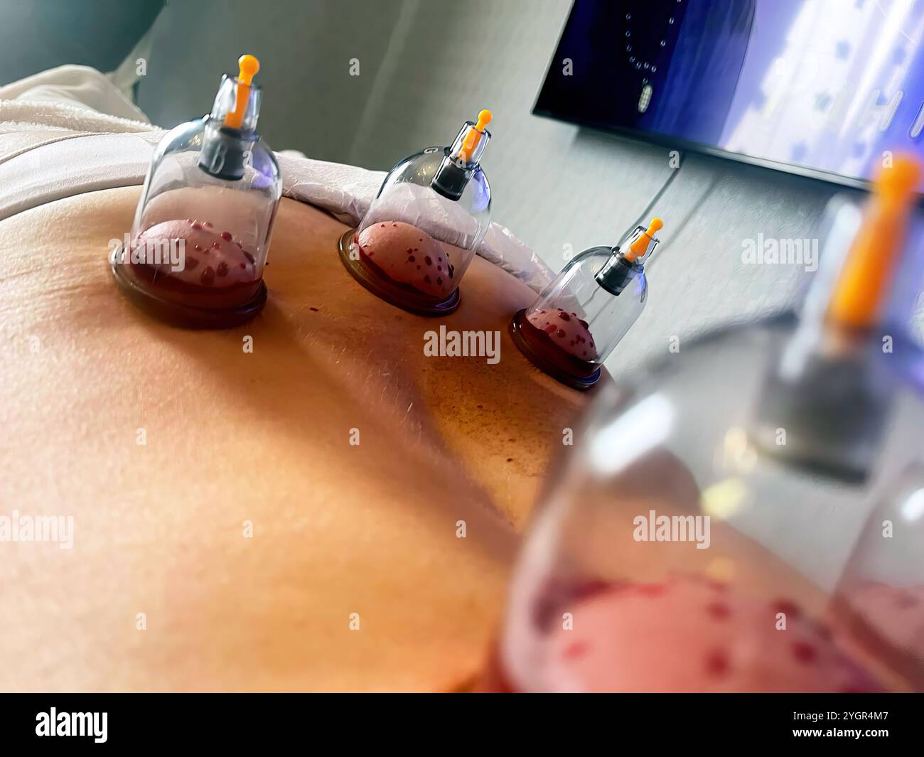 Le pouvoir curatif de Hijama : avantages de Cupping pour les saignées. Affûtage sélectif Banque D'Images
