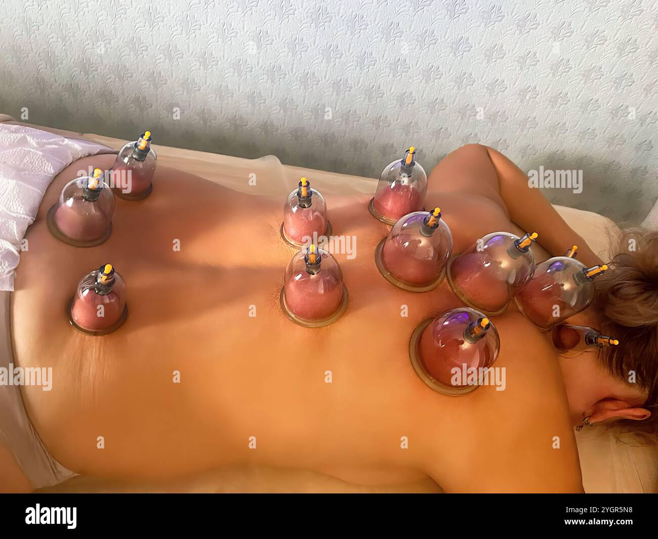 Le pouvoir curatif de Hijama : avantages de Cupping pour les saignées. Affûtage sélectif Banque D'Images