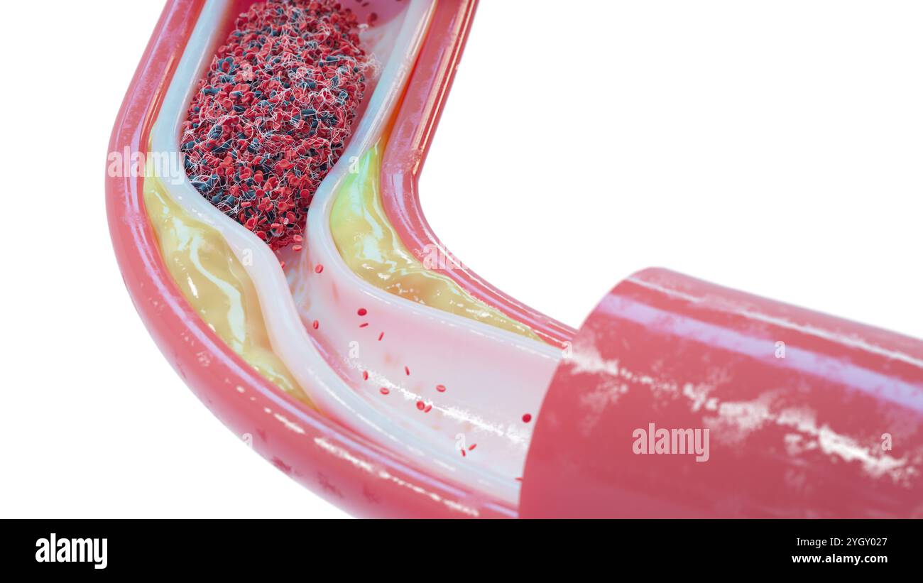 Illustration d'un vaisseau sanguin avec athérosclérose et caillot sanguin (thrombus). L'athérosclérose est un rétrécissement (sténose) d'une artère dû à des dépôts graisseux (jaunes) sur ses parois internes. Les dépôts sont constitués d'athérome, une substance comprenant du cholestérol, des cellules en décomposition, des cellules sanguines et des protéines grasses. Les dommages aux parois peuvent également provoquer la formation d'un thrombus, ce qui peut perturber la circulation sanguine. Un thrombus peut être fatal s’il bloque le flux sanguin vers un organe vital, comme le cerveau. Banque D'Images