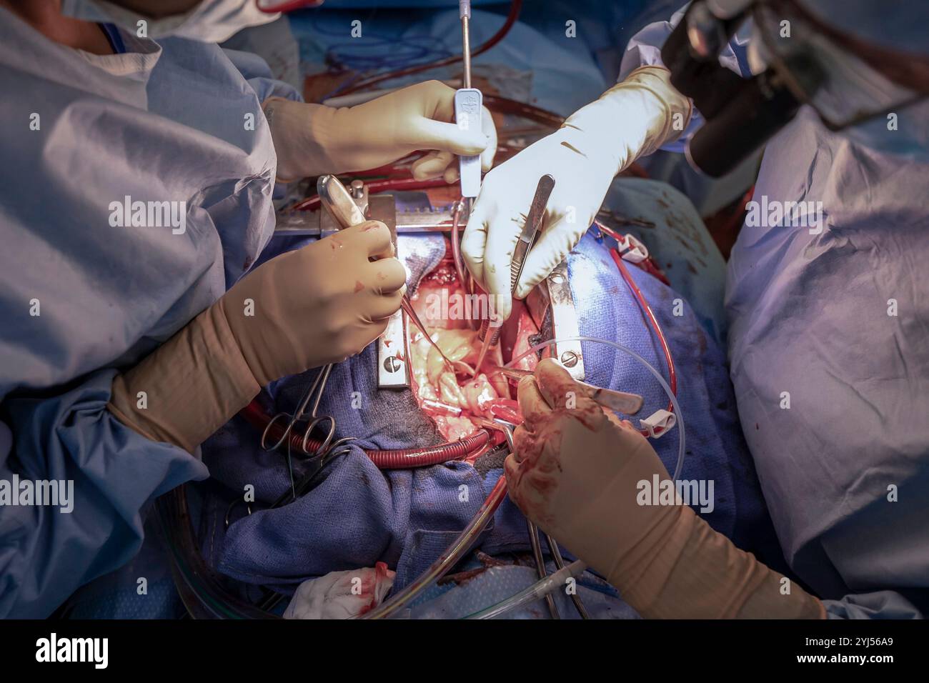 Une équipe chirurgicale effectue une intervention chirurgicale cardiaque complexe avec une grande précision Banque D'Images