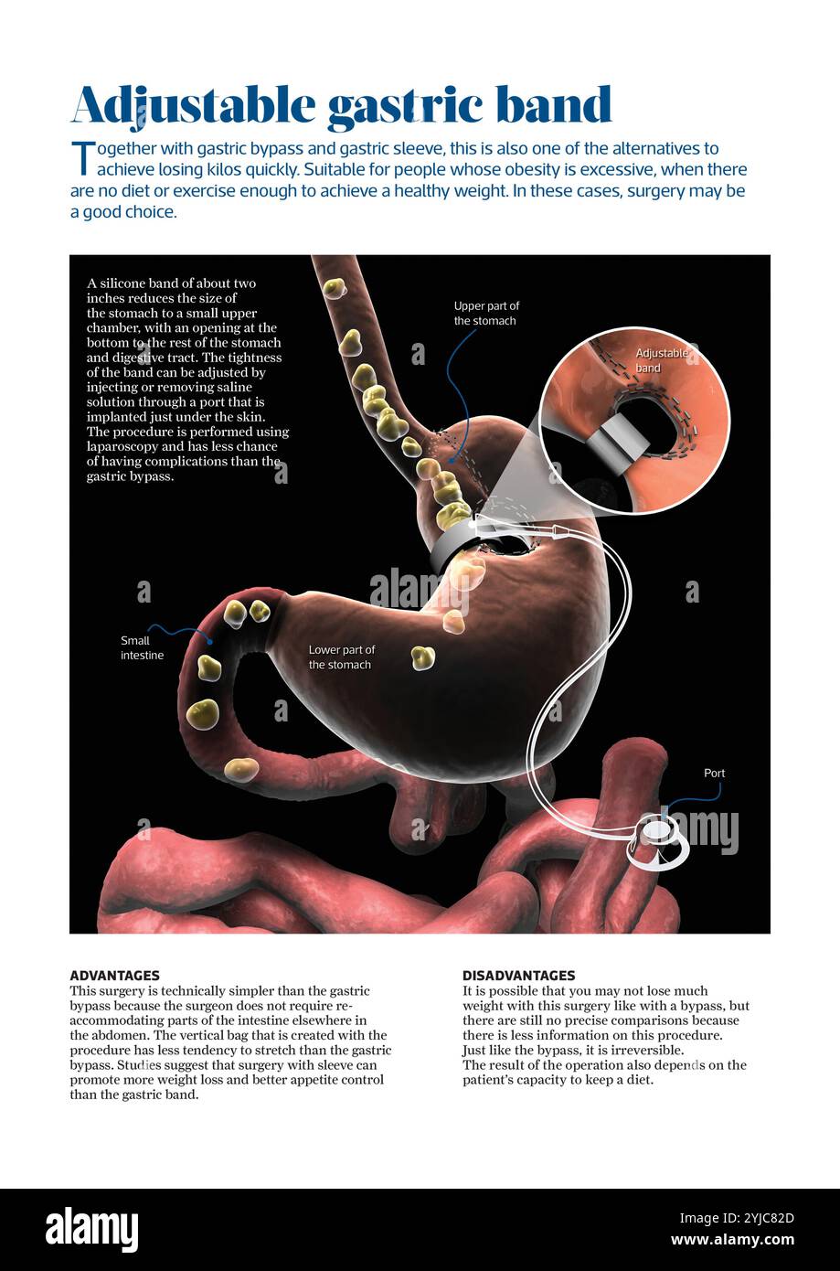 Infographie qui explique ce qu'est la procédure chirurgicale de bande gastrique réglable. [Adobe InDesign (.INDD) ; 3535x5000]. Banque D'Images