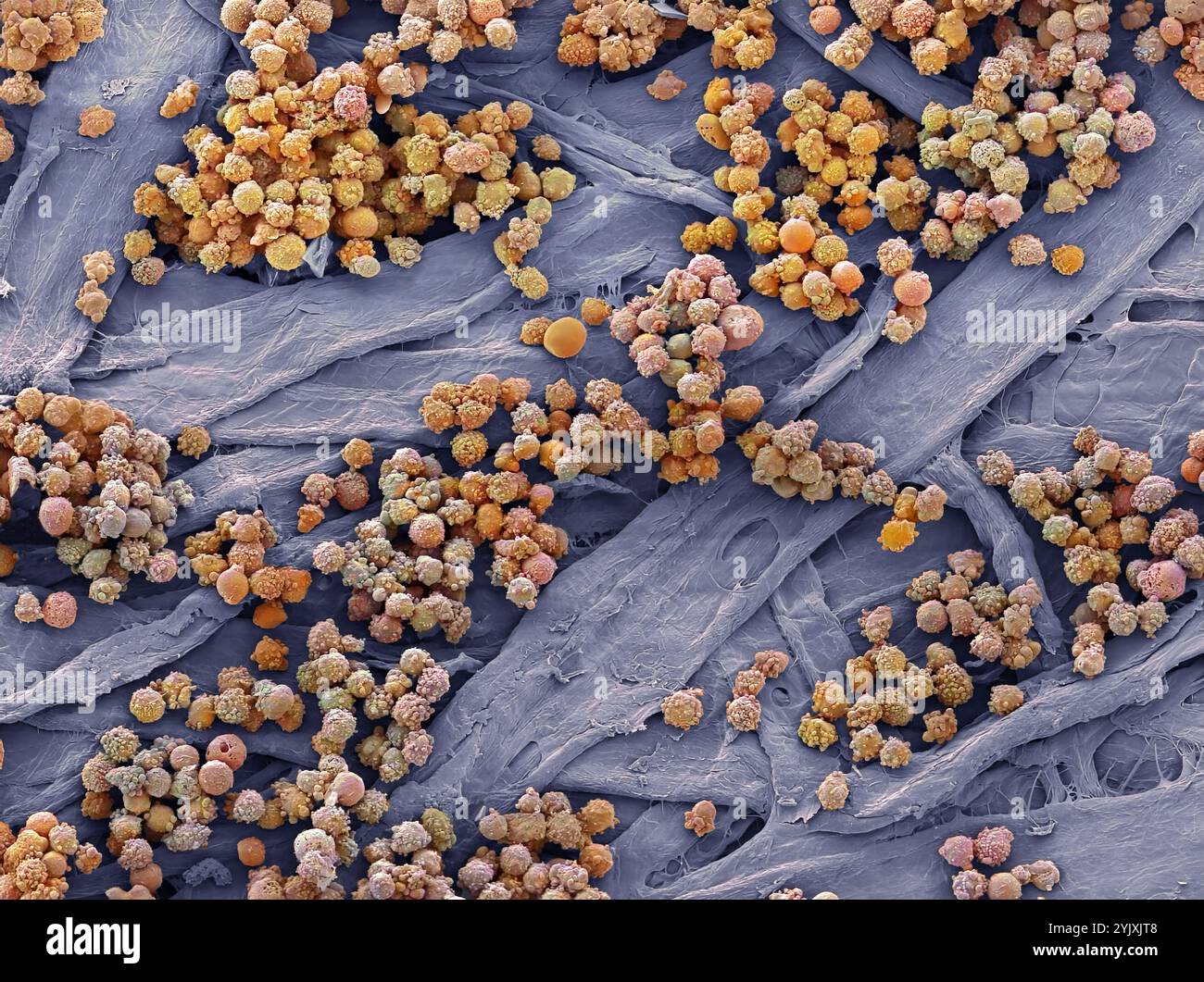 Leucémies sanguines. Micrographie électronique à balayage couleur (MEB) des globules blancs d'un patient atteint de leucémie lymphoïde chronique. Cette forme de cancer se trouve le plus souvent chez les personnes âgées et implique une augmentation des taux circulants de lymphocytes (un type de globules blancs), comme on le voit ici. Cela entraîne une réduction de la proportion de globules rouges, entraînant une anémie, ainsi que d’autres complications telles que l’hypertrophie du foie et de la rate. Grossissement : x1000 lors de l'impression à 10 centimètres de large. Banque D'Images