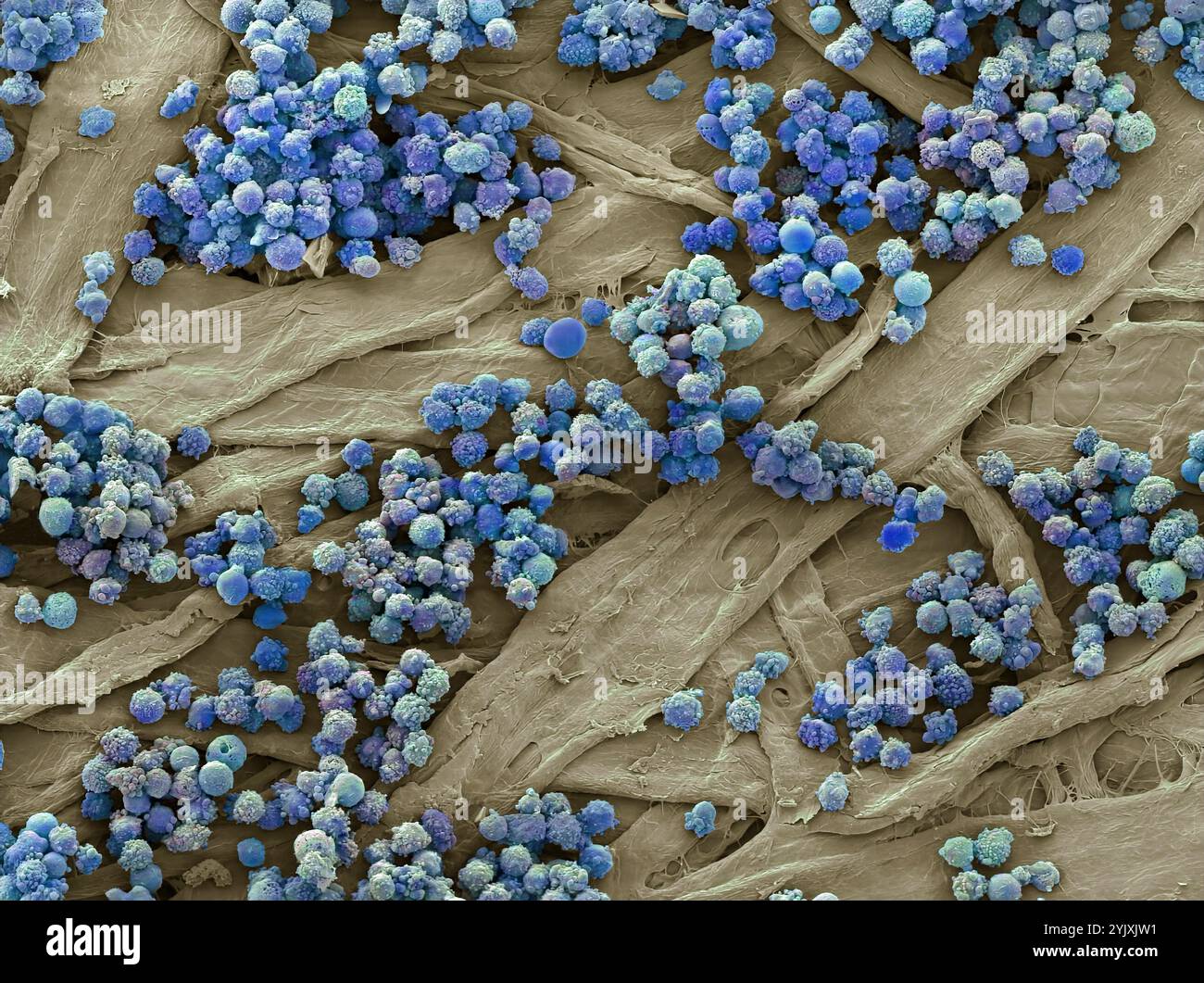 Leucémies sanguines. Micrographie électronique à balayage couleur (MEB) des globules blancs d'un patient atteint de leucémie lymphoïde chronique. Cette forme de cancer se trouve le plus souvent chez les personnes âgées et implique une augmentation des taux circulants de lymphocytes (un type de globules blancs), comme on le voit ici. Cela entraîne une réduction de la proportion de globules rouges, entraînant une anémie, ainsi que d’autres complications telles que l’hypertrophie du foie et de la rate. Grossissement : x1000 lors de l'impression à 10 centimètres de large. Banque D'Images
