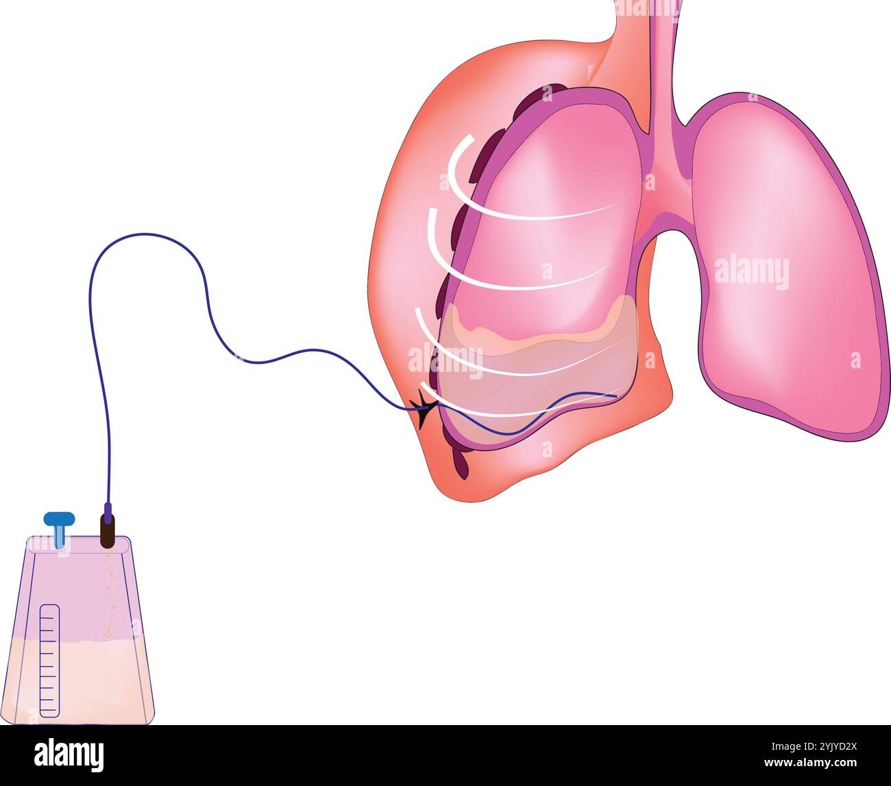 Schéma d'épanchement pleural Illustration de Vecteur