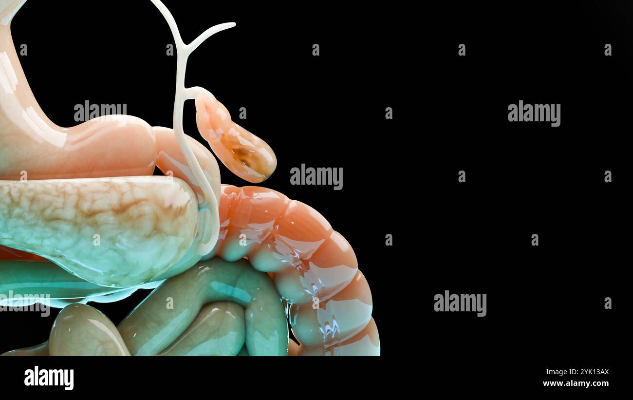 Calculs biliaires dans le canal biliaire, silhouette humaine et anatomie des organes environnants, foie et vésicule biliaire avec calculs, rendu réaliste 3D Banque D'Images