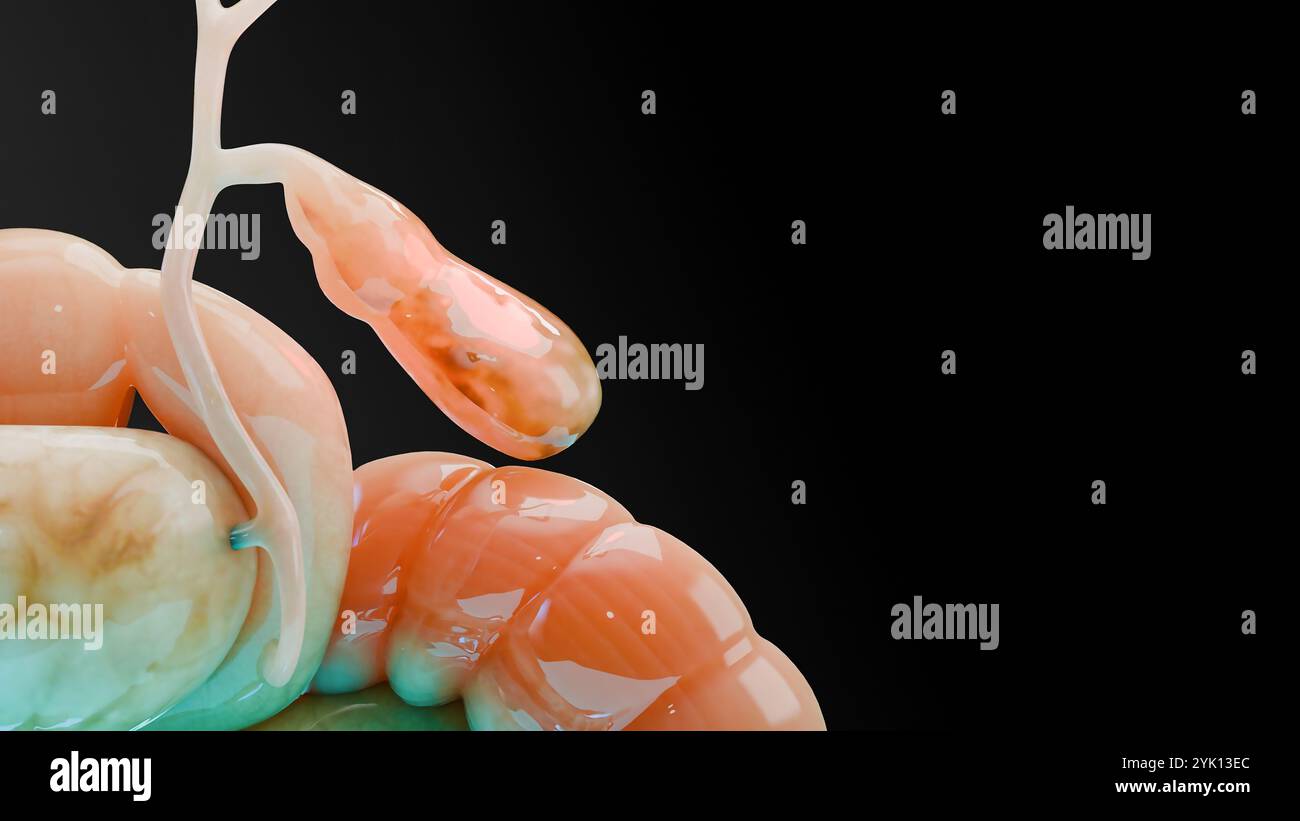 Calculs biliaires dans le canal biliaire, silhouette humaine et anatomie des organes environnants, foie et vésicule biliaire avec calculs, rendu réaliste 3D Banque D'Images