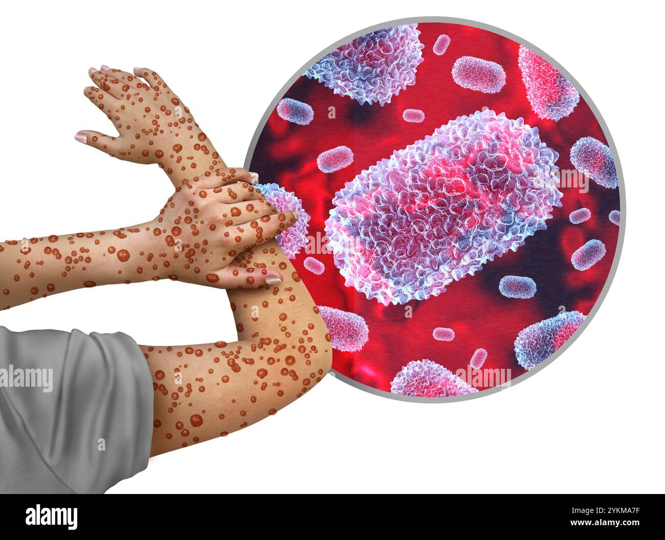 Éclosion du virus de la pox ou de la variole du singe comme une infection contagieuse comme des cloques et des léisons sur la peau représentant la transmission d'une personne infectée. Banque D'Images Éclosion du virus de la pox ou de la variole du singe comme une infection contagieuse comme des cloques et des léisons sur la peau représentant la transmission d'une personne infectée. Banque D'Images