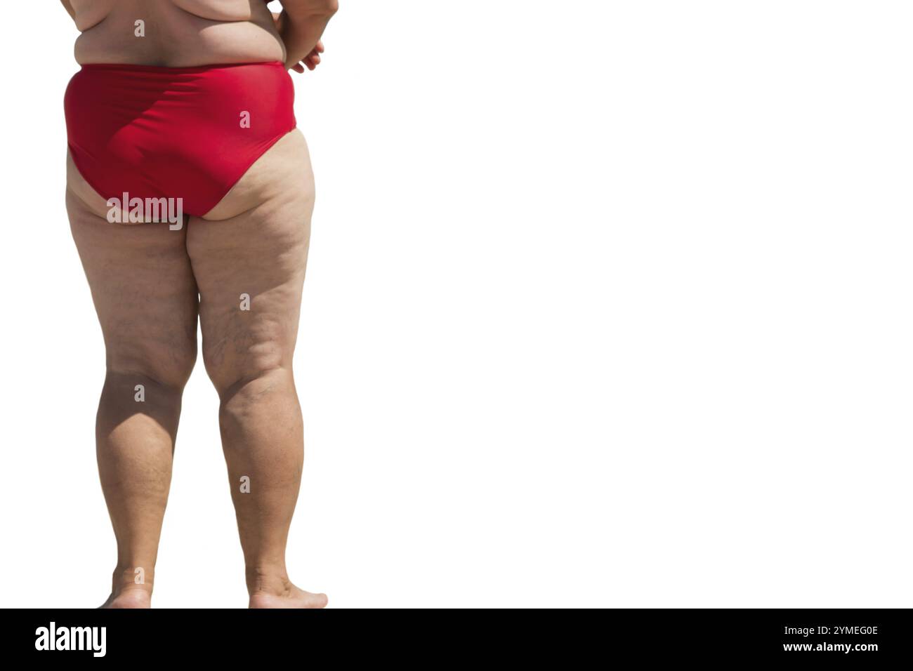 Jambes d'une personne en surpoids. Femme obèse isolée. Effets d'une mauvaise alimentation. Problèmes de métabolisme Banque D'Images