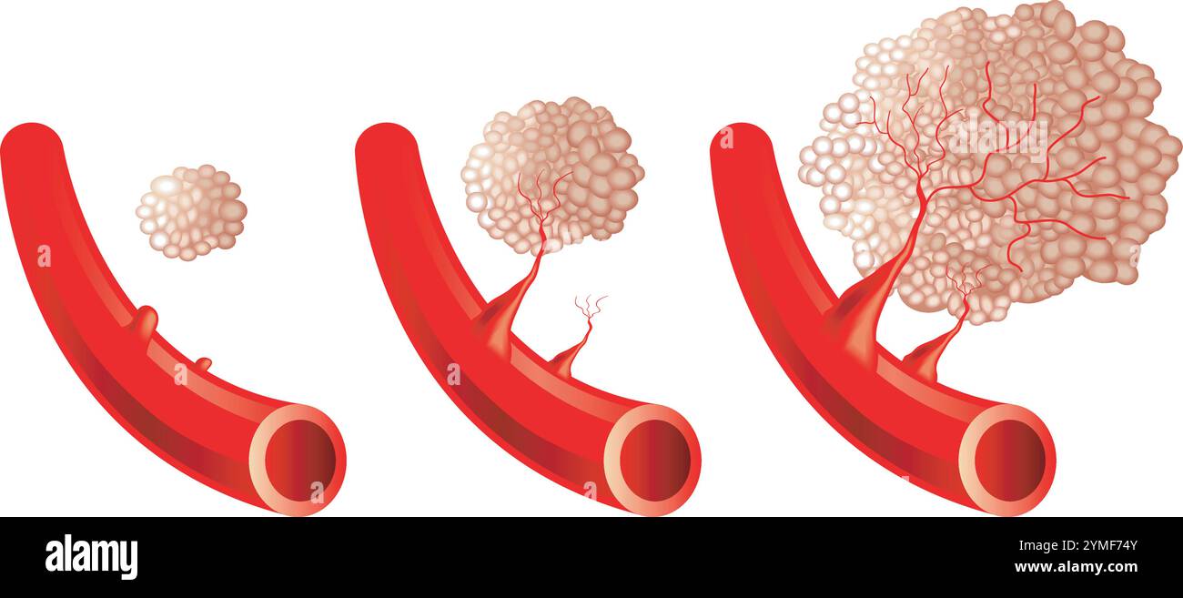 Illustration médicale de la progression de l'angiogenèse. Illustration de Vecteur