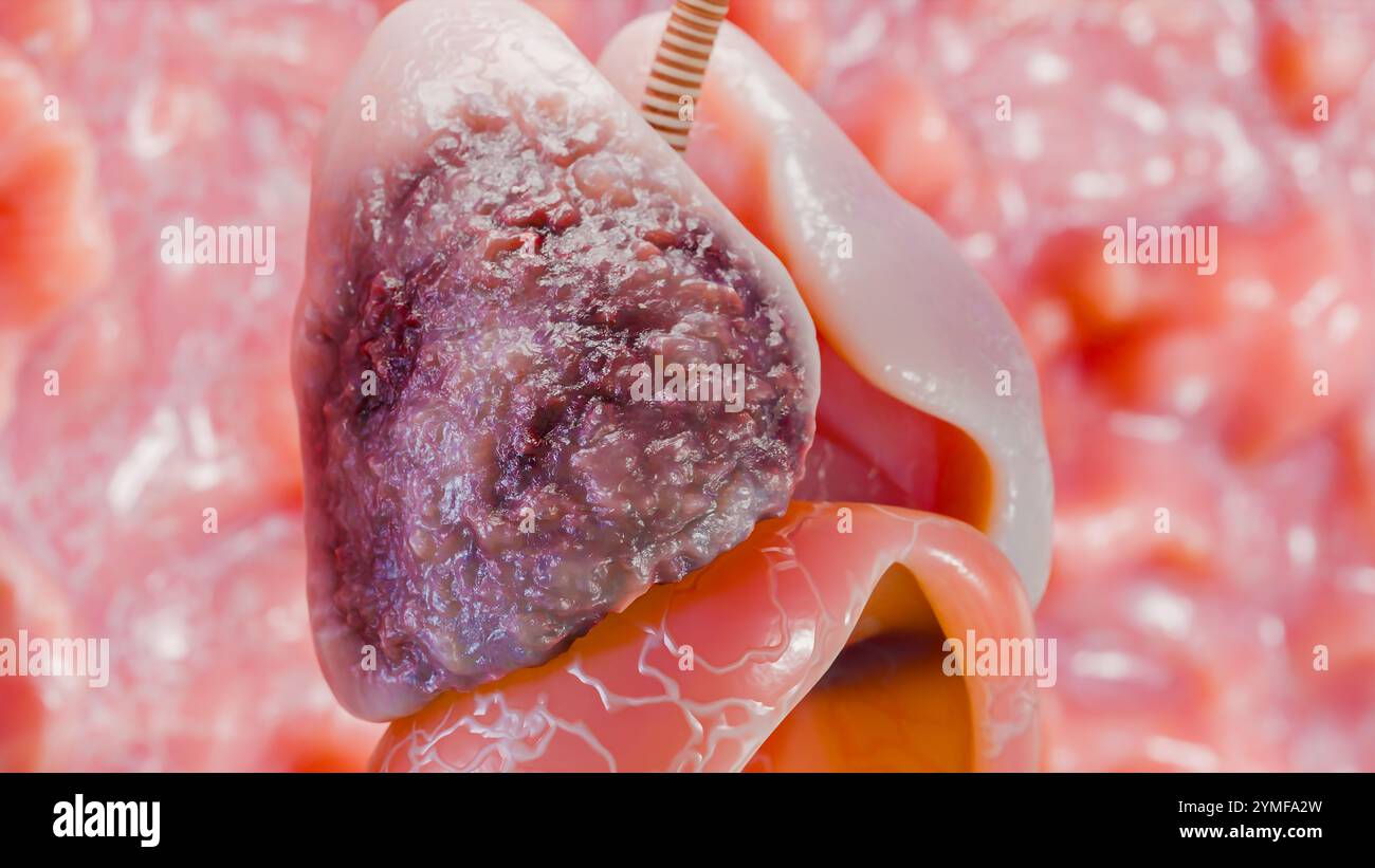 Pneumonie maladie, poumons sains et maladies poumons, cancer des poumons humains, fumeurs de cigarettes maladie pulmonaire, tumeur maligne cancéreuse en croissance et propagation Banque D'Images