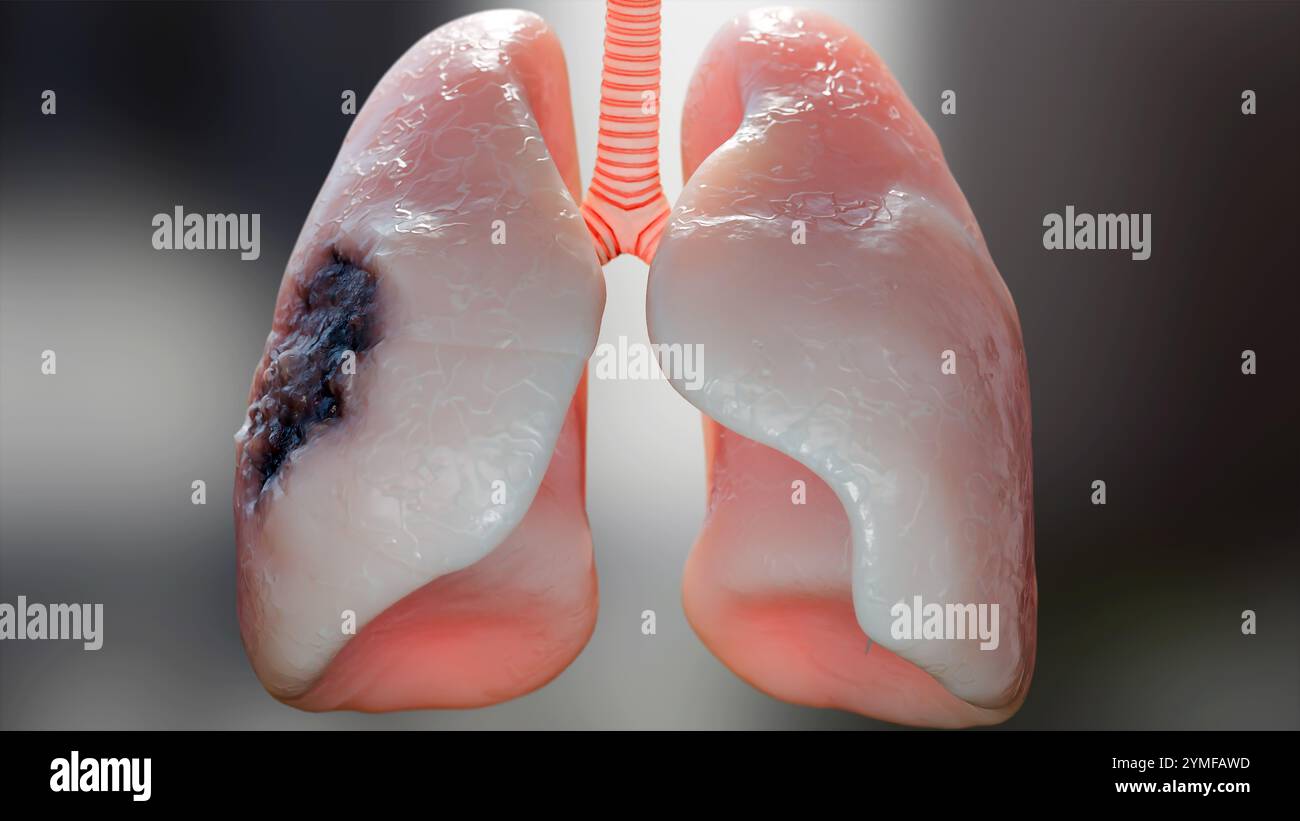 Pneumonie maladie, poumons sains et maladies poumons, cancer des poumons humains, fumeurs de cigarettes maladie pulmonaire, tumeur maligne cancéreuse en croissance et propagation Banque D'Images