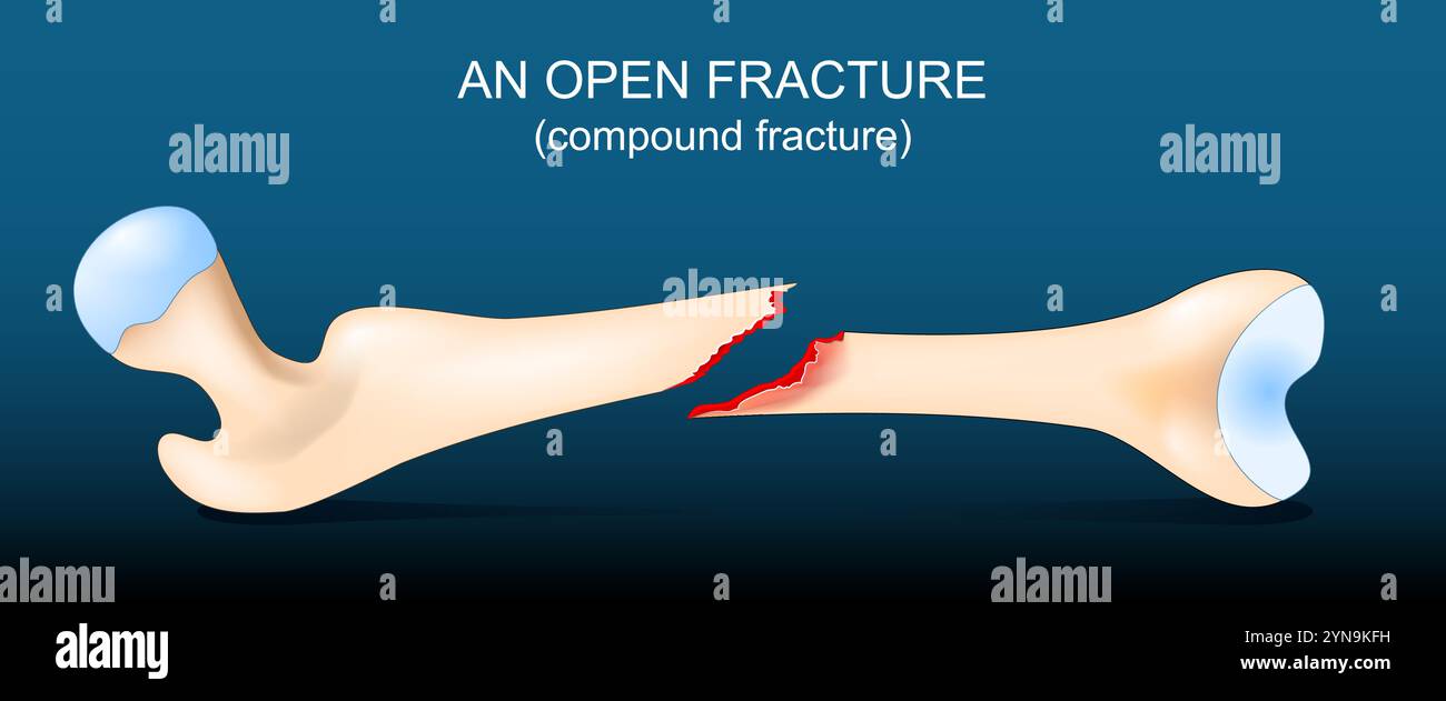 Fracture composée de l'os fémoral. Fracture ouverte. Fémur humain cassé sur fond sombre. Illustration vectorielle. Illustration de Vecteur