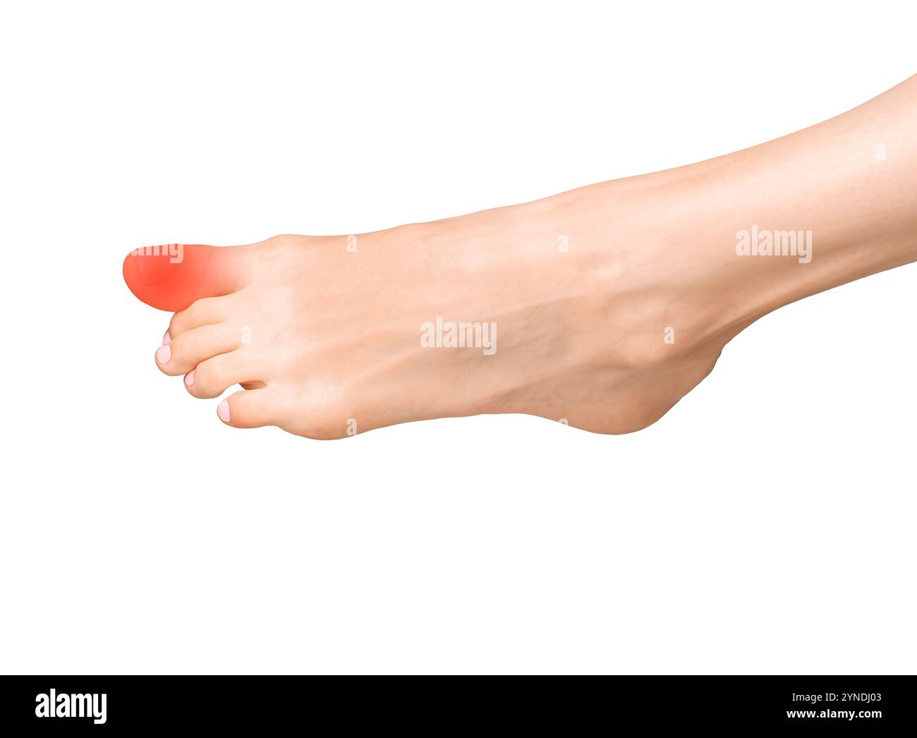 Douleur au gros orteil, douleurs articulaires et inflammation. Pied douloureux avec entorse, ecchymose tendineuse et contusion calcanéenne. Arthrite chronique, tension musculaire et neuro Banque D'Images Douleur au gros orteil, douleurs articulaires et inflammation. Pied douloureux avec entorse, ecchymose tendineuse et contusion calcanéenne. Arthrite chronique, tension musculaire et neuro Banque D'Images