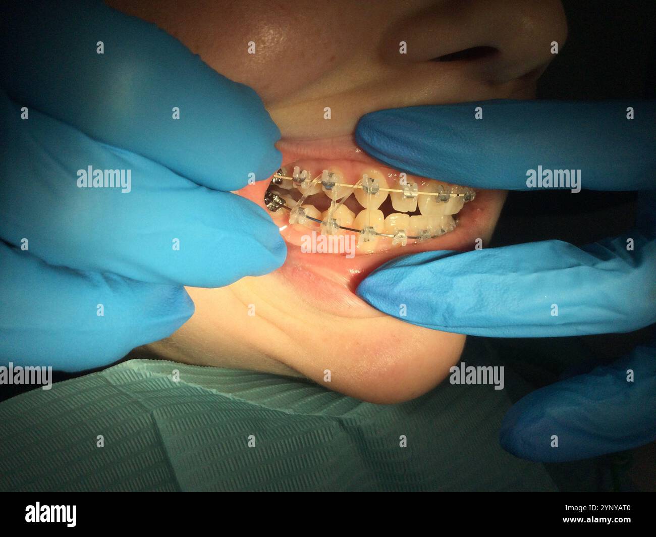 Un professionnel dentaire ajuste les bagues sur les dents d'un patient dans un environnement clinique. Le patient reçoit des soins orthodontiques, démontrant pro Banque D'Images