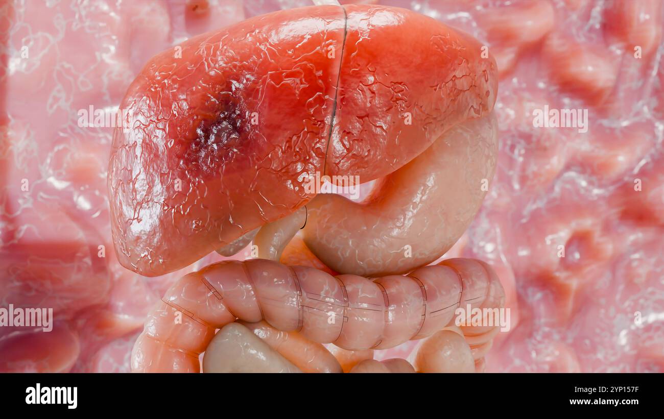 Cancer du foie d'organe digestif, hépatite cirrhose tumeur maligne, insuffisance hépatique, cellules en croissance, duplication, fibrose, cirrhose, hépatocellulaire ca Banque D'Images