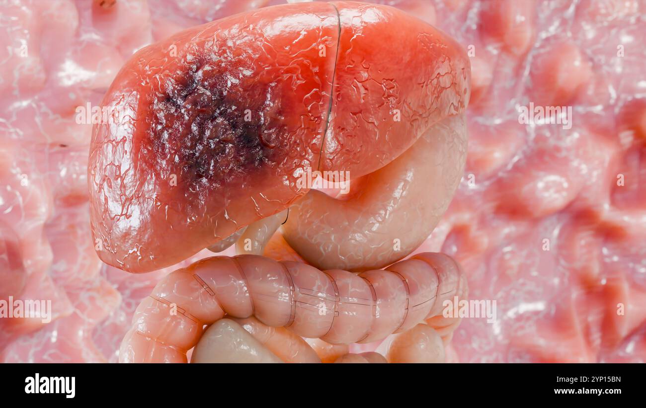 Cancer du foie d'organe digestif, hépatite cirrhose tumeur maligne, insuffisance hépatique, cellules en croissance, duplication, fibrose, cirrhose, hépatocellulaire ca Banque D'Images