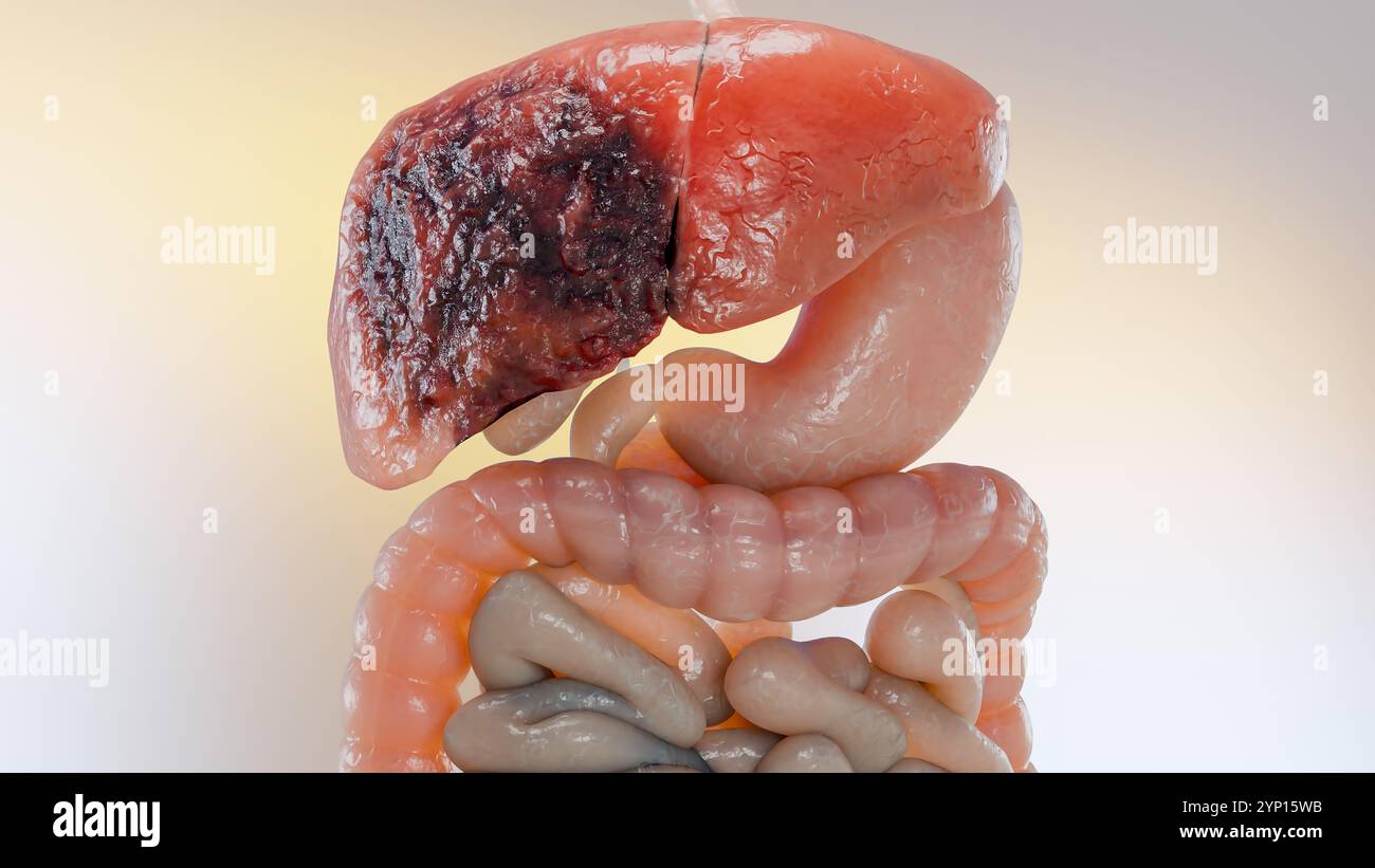 Cancer du foie d'organe digestif, hépatite cirrhose tumeur maligne, insuffisance hépatique, cellules en croissance, duplication, fibrose, cirrhose, hépatocellulaire ca Banque D'Images