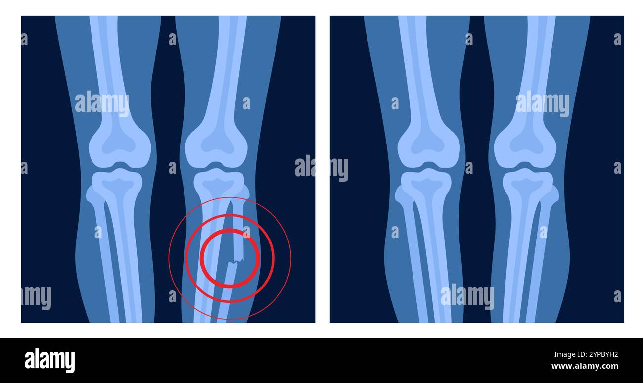 Radiographie de fracture de jambe avec point douloureux rouge. Jambe cassée avec fracture ouverte. Concept d'anatomie du squelette humain. Bannière médicale pour clinique ou hospita Illustration de Vecteur