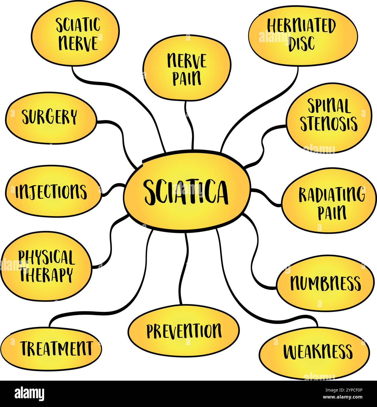 Sciatique se réfère à la douleur qui rayonne le long du chemin du nerf sciatique, le plus grand nerf dans le corps, infographie vectorielle de carte mentale. Illustration de Vecteur
