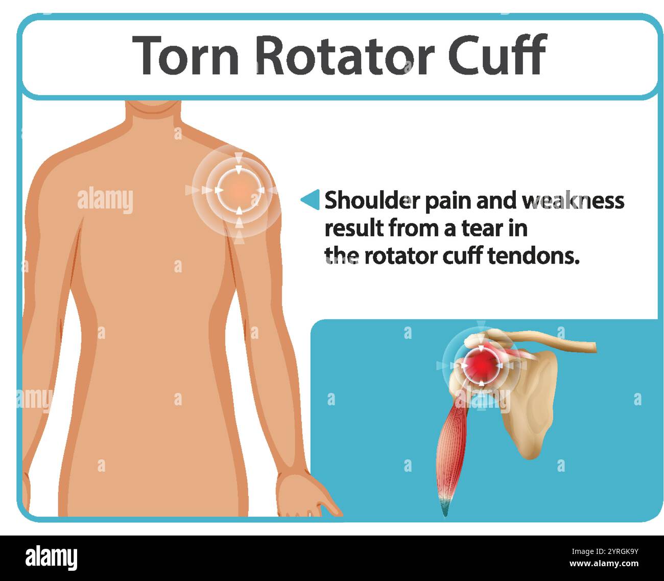 Illustration de douleurs à l'épaule et déchirure du tendon Illustration de Vecteur