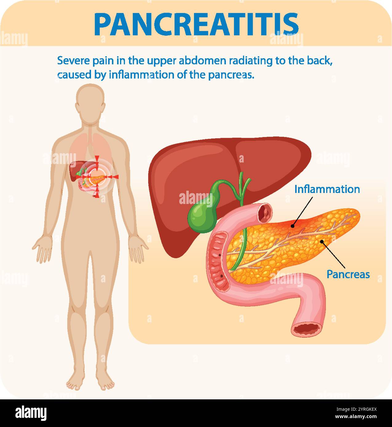 Illustration de l'inflammation du pancréas et de la douleur associée Illustration de Vecteur