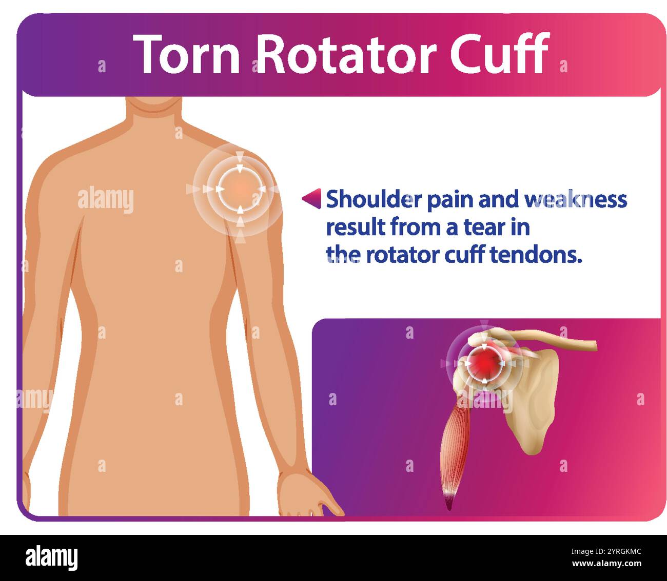 Illustration de douleurs à l'épaule et déchirure du tendon Illustration de Vecteur