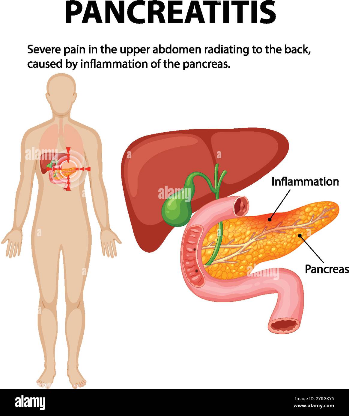 Illustration de l'inflammation du pancréas et de la douleur associée Illustration de Vecteur