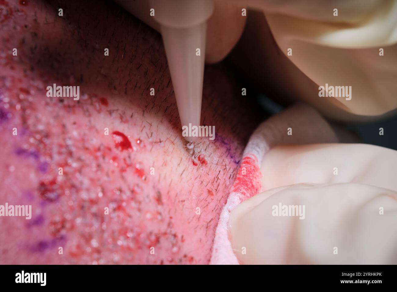 Un gros plan détaillé d'une procédure de greffe de cheveux, mettant en évidence la greffe de follicules dans le cuir chevelu L'image capture la précision et le soin pendant le médicament Banque D'Images